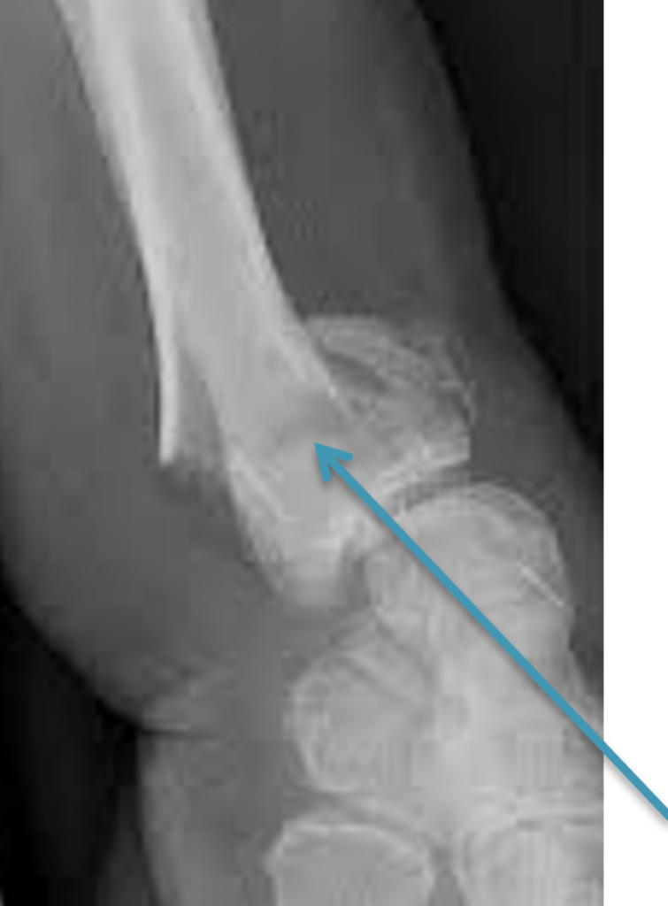 Fracture du chez l’adulte IECEM